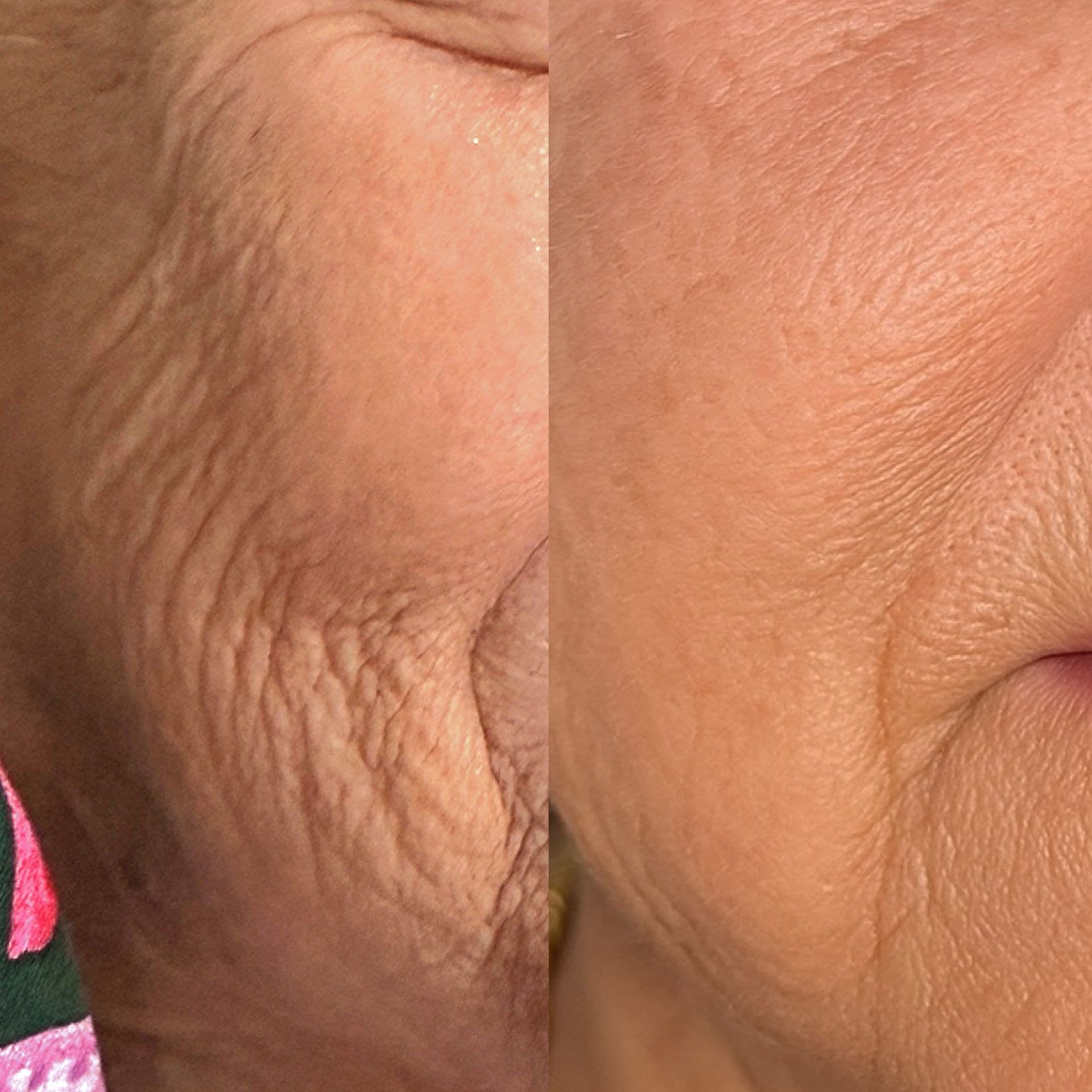 Close-up of one patient's cheek skin before treatment (left) and after (right)