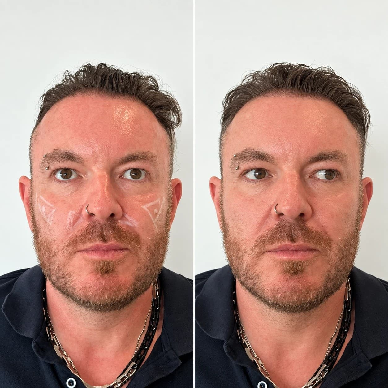 The same patient's face from the front before treatment (left) and after (right)