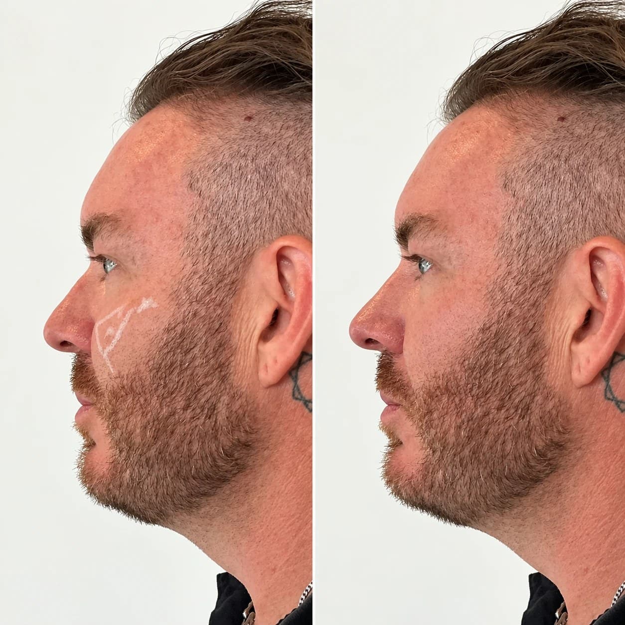 One patient's face in profile before treatment (left) and after (right)