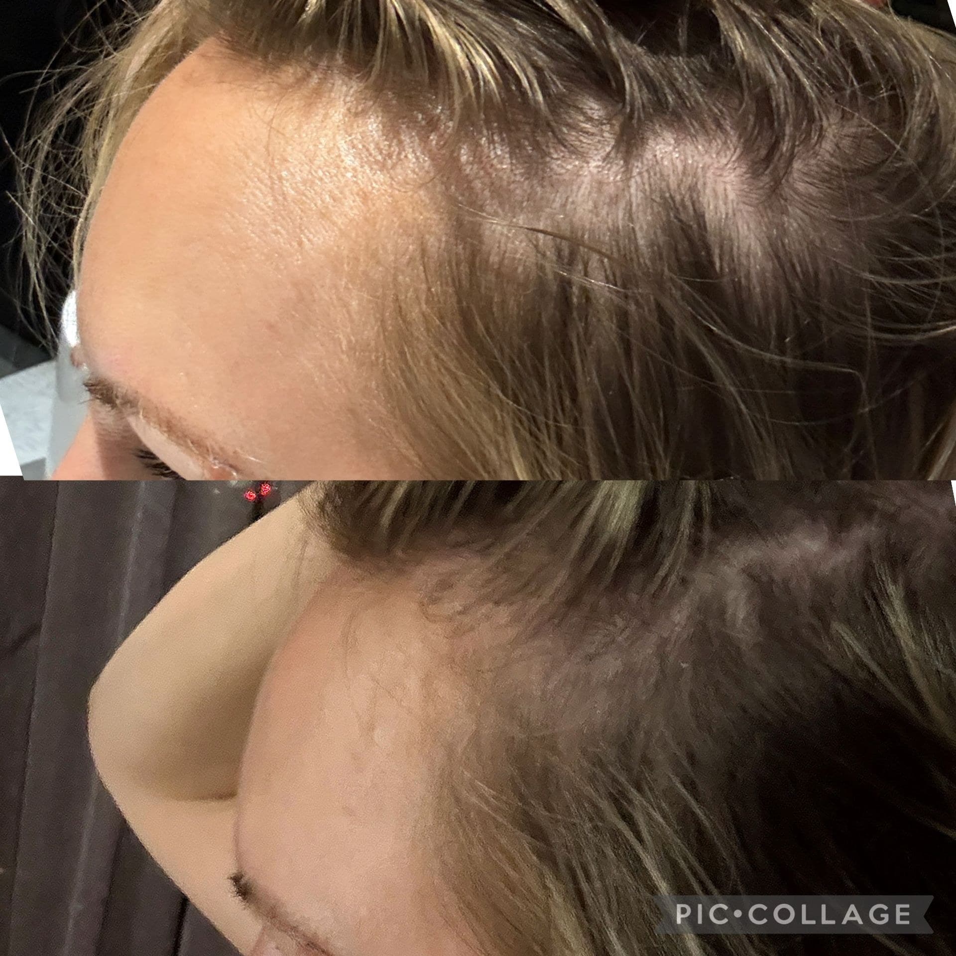One patient's hairline at the temple photographed before treatment (top) and after (bottom)