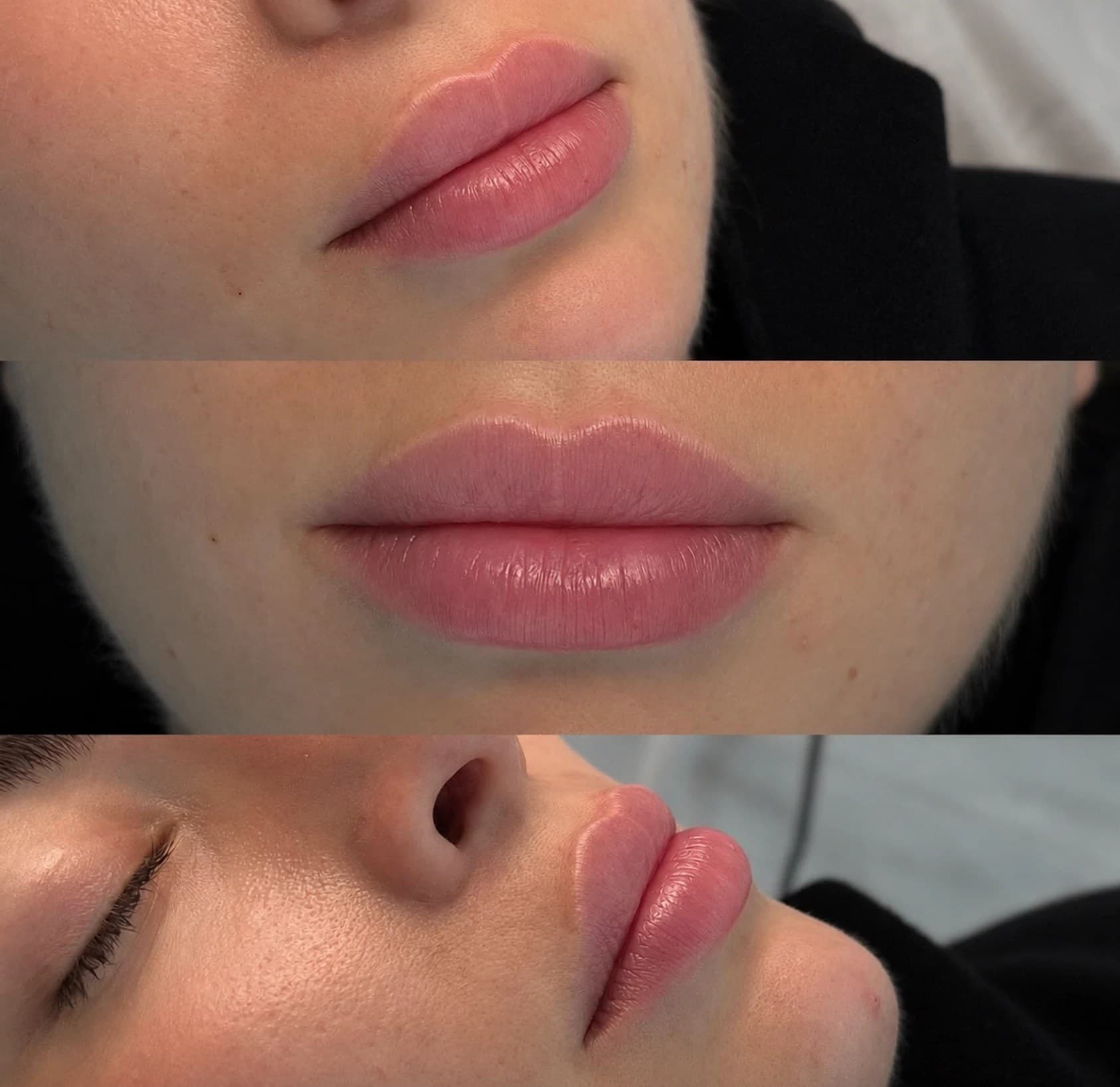 One patient's lips photographed from three angles after treatment