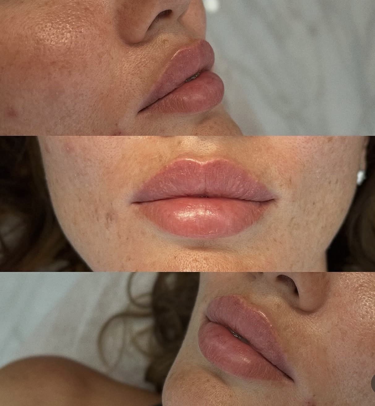 One patient's lips photographed from three angles after treatment