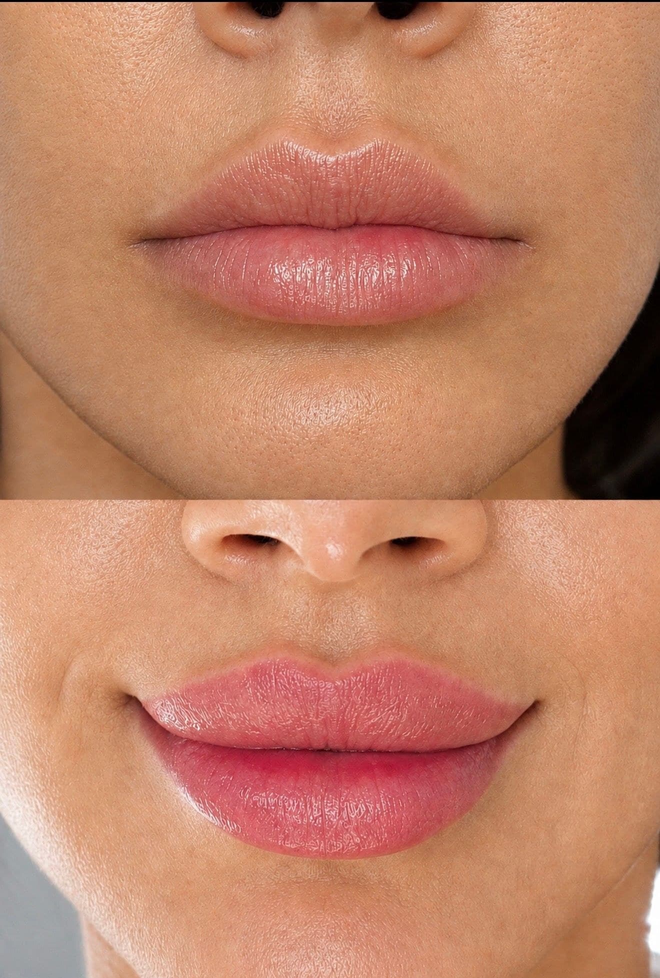 One patient's lips photographed before treatment (top) and after (bottom)