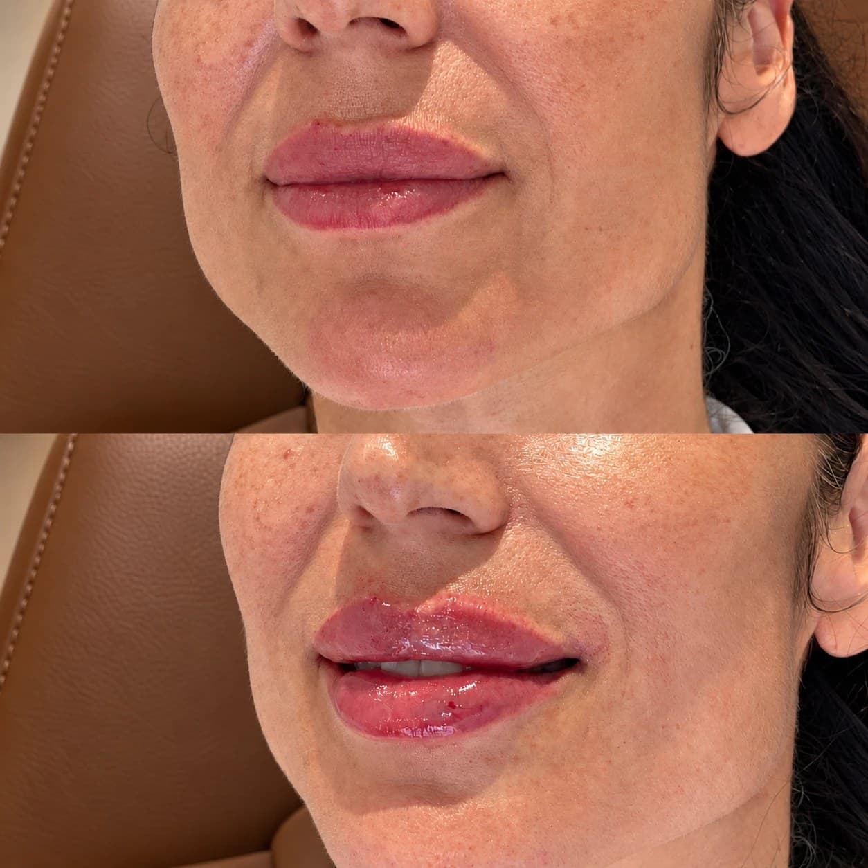One patient's lips at an angle, photographed before treatment (top) and straight after (bottom)