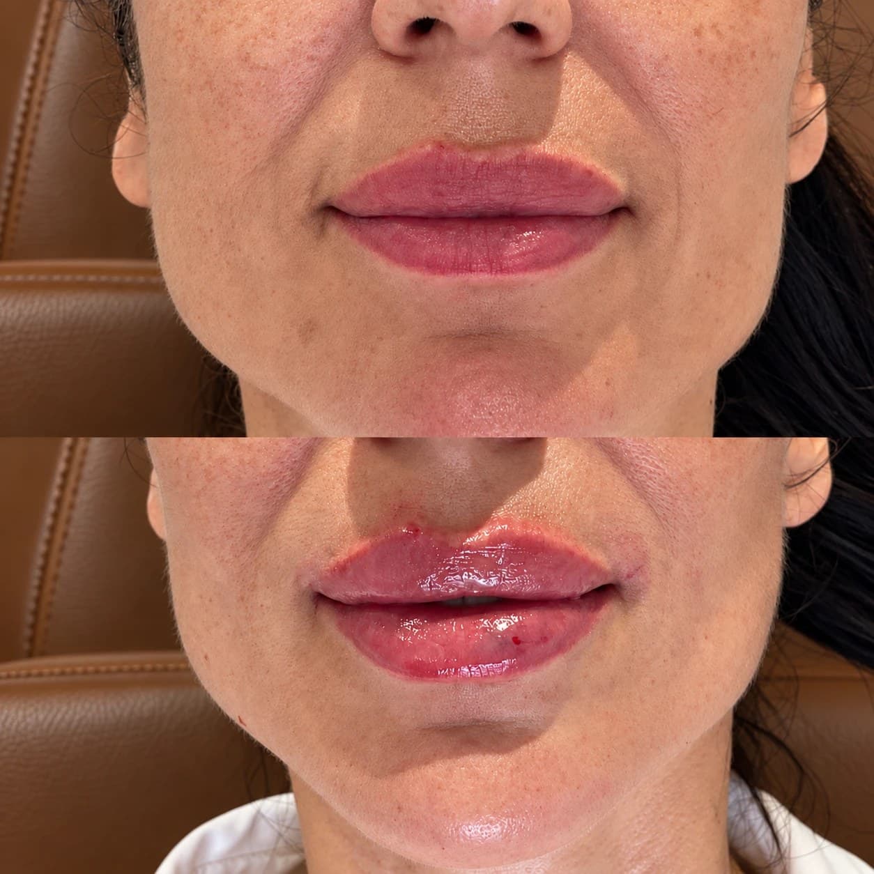 The same patient's lips from the front, photographed before treatment (top) and straight after (bottom)