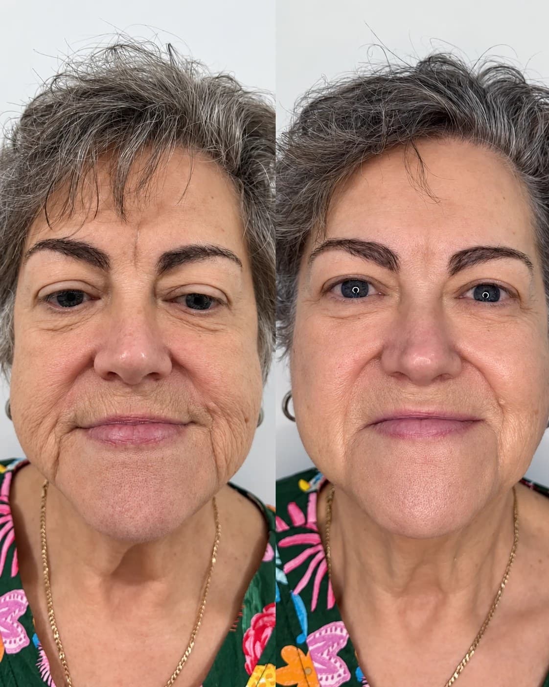 One patient's face from the front before a thread lift (left) and after (right)
