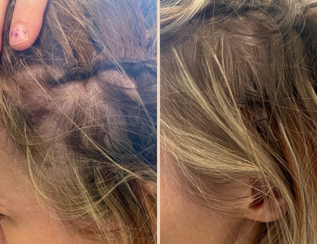 Hair loss treatment