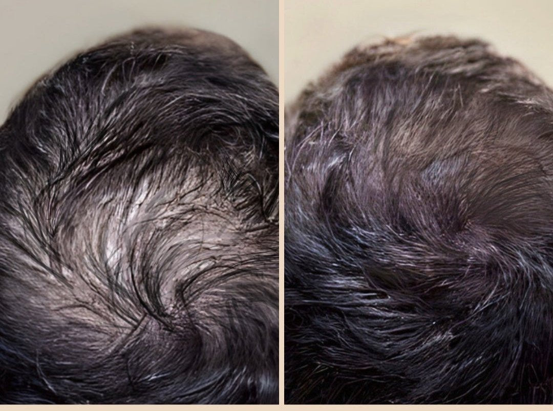 Hair loss treatment